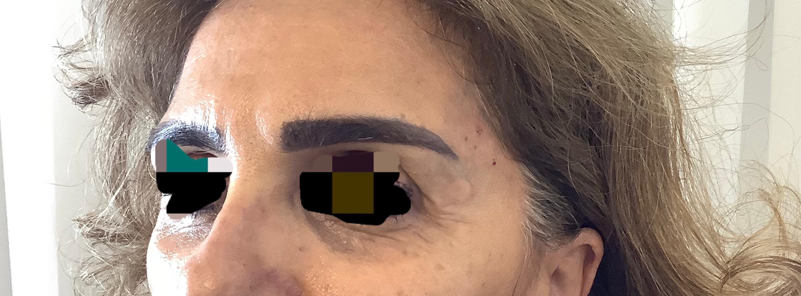 אחרי מילוי רקות