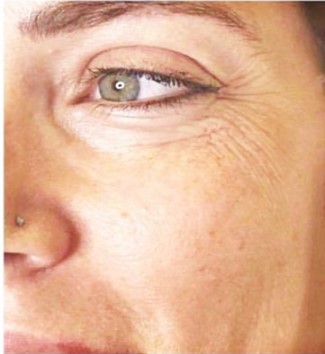 בוטוקס אחרי