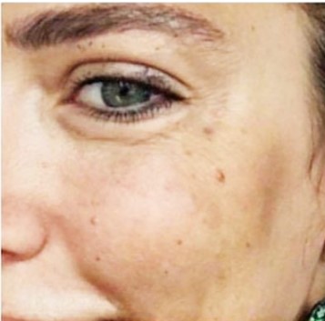 בוטוקס לפני