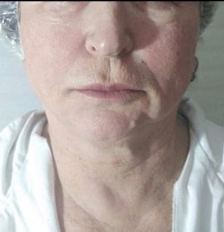 טיפול בעייפות אחרי