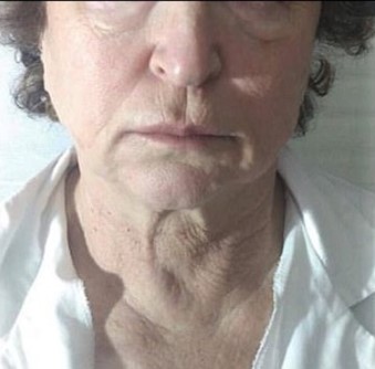 טיפול בעייפות לפני