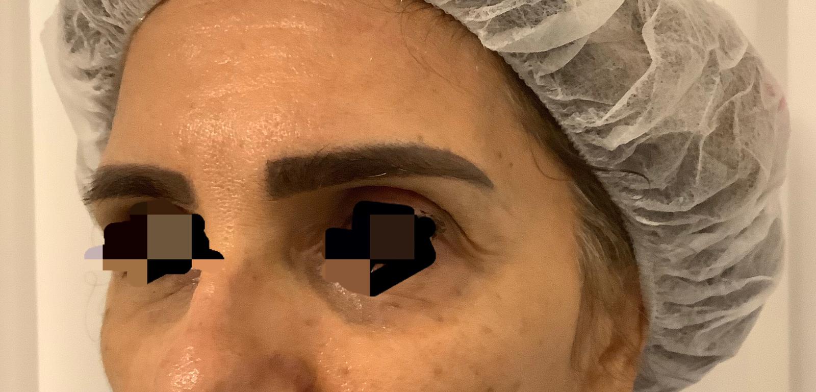 לפני מילוי רקות