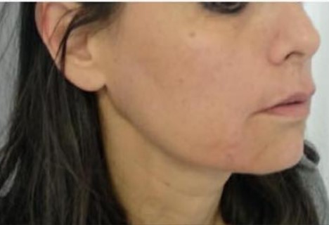 מימת הסידן אחרי