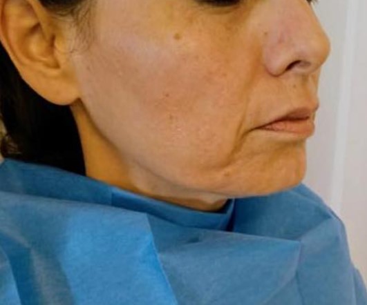 מימת הסידן לפני