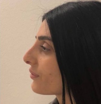 פיסול אף אחרי