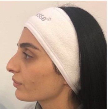 פיסול אף לפני