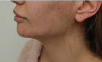 פיסול סנטר אחרי