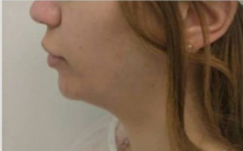 פיסול סנטר לפני