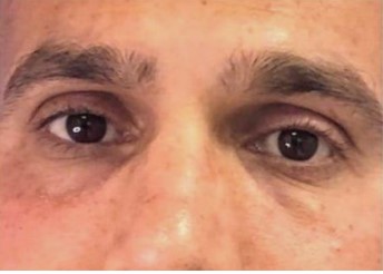 שקעי עיניים אחרי