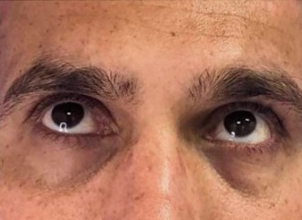 שקעי עיניים לפני